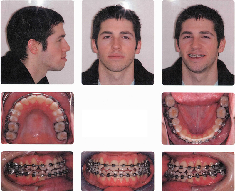 before/after underbite surgery Orthognathic surgery is performed on a